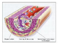 cholesterol_15-11-2011